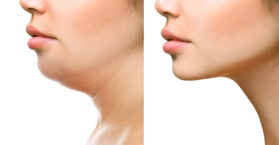 Getting Rid of Your Double Chin: How Liposuction Can Help