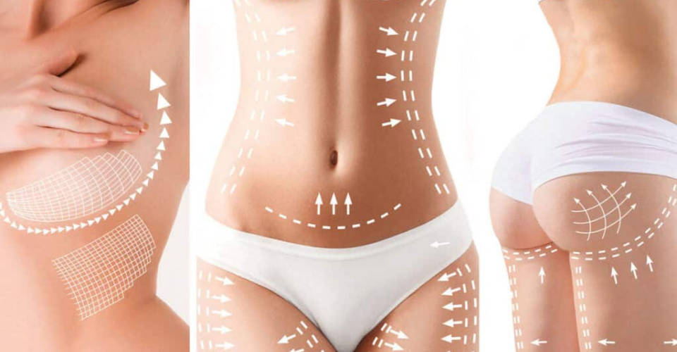 High-Intensity Focused Electromagnetic (HIFEM): A Non-Invasive Approach to Body Contouring