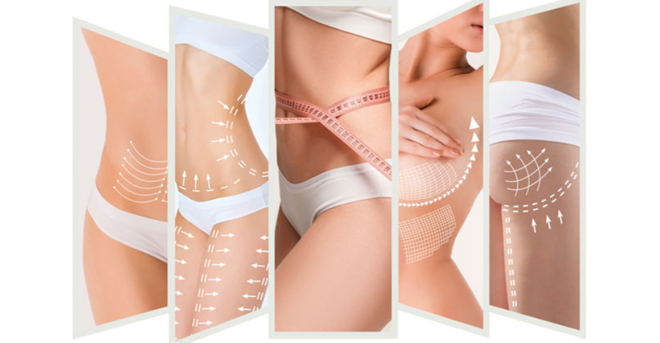 CoolSculpting