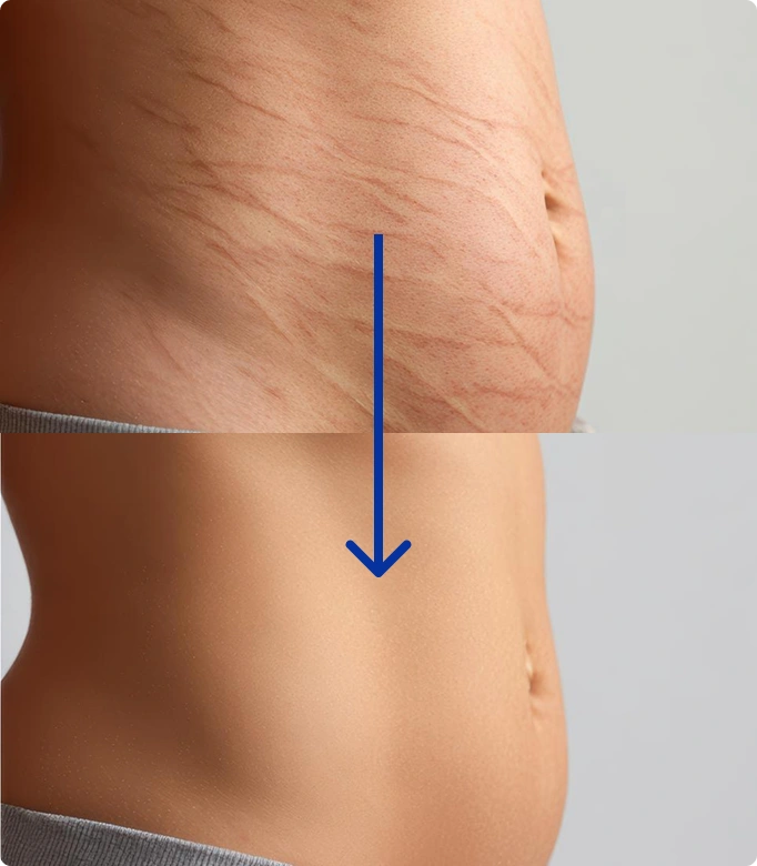 Stretch marks on a woman's side, showing areas in need of stretch marks removal treatment.