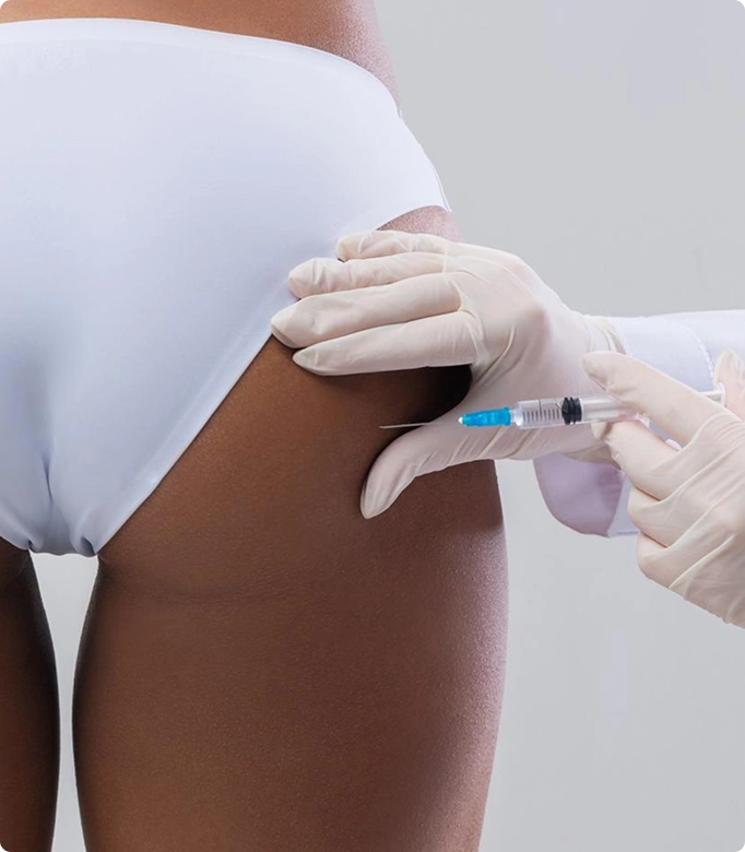 Gluteal augmentation by fat injection procedure with markings on the buttocks for fat transfer.