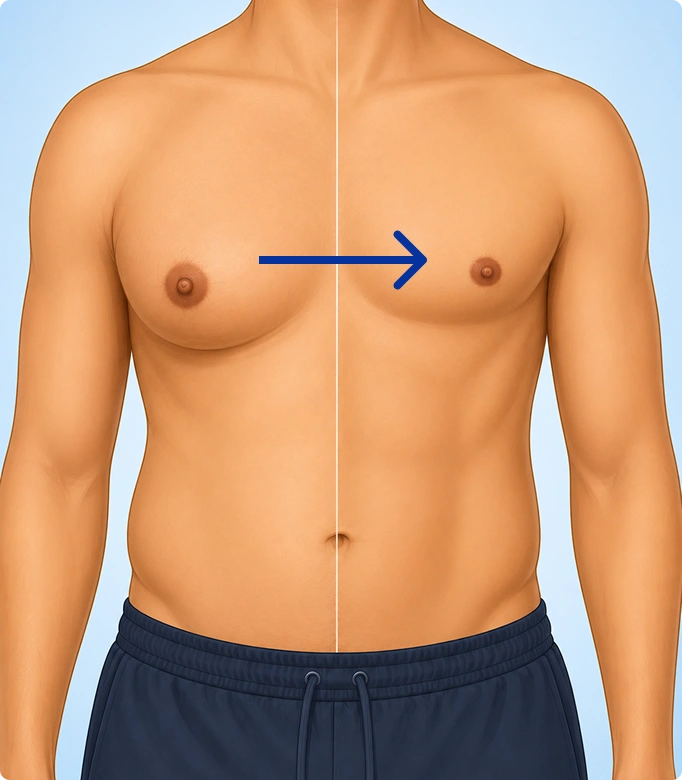 Male breast correction procedure with markings on a man’s chest for gynecomastia surgery.