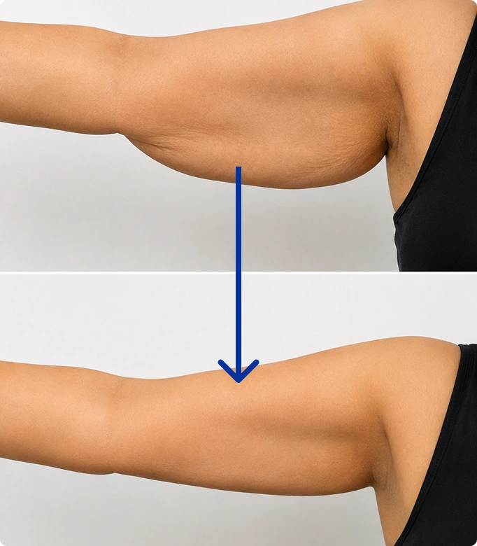 Arm lift procedure markings on a woman's arm for excess skin removal and contouring.