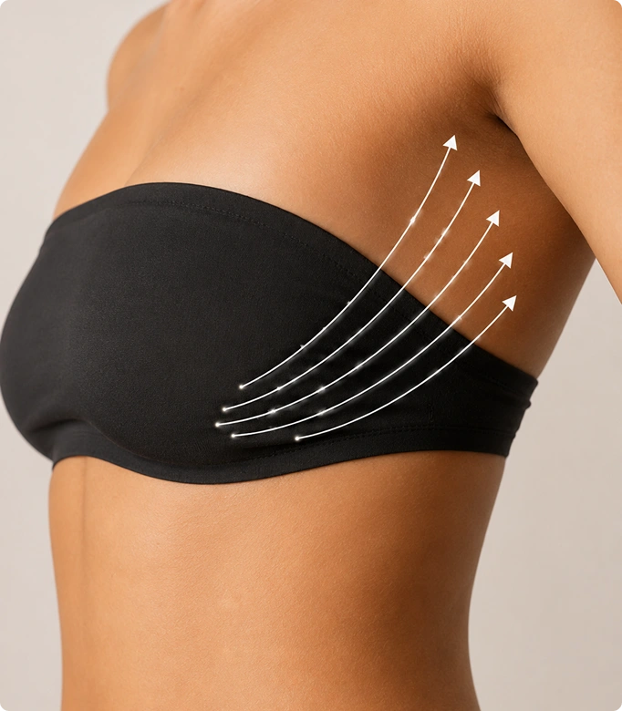 Illustration showing the process of a thread lift procedure to lift and tighten the breast tissue for enhanced contour.