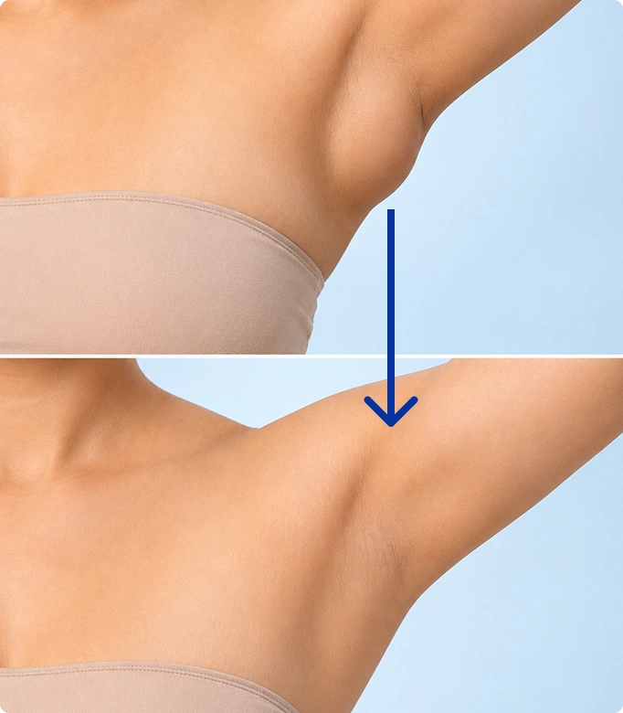 Axillary breast correction treatment, targeting excess tissue under the arm for a smoother contour.