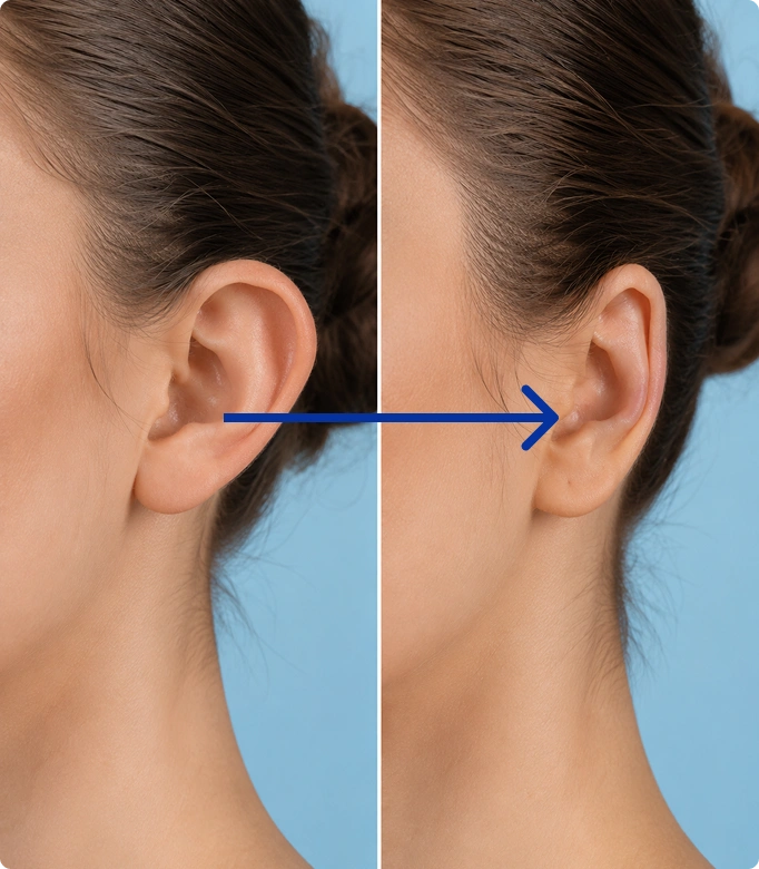 Before and after ear correction procedure showing improved ear shape and position.