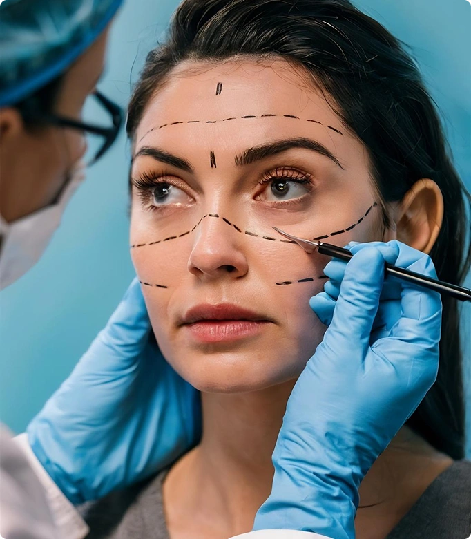 Face lift procedure preparation with markings on a woman's face for facial contouring.