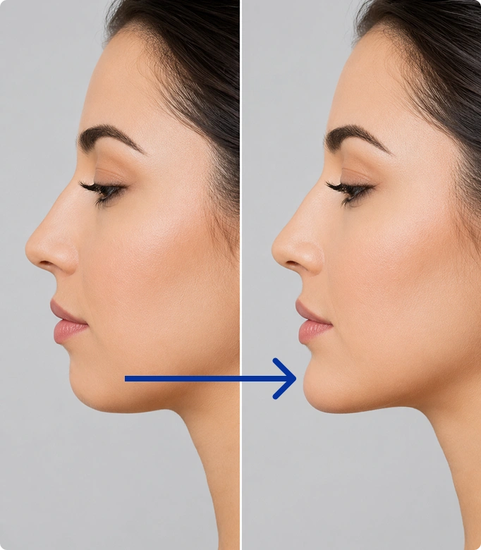 Chin implant being held near the chin for a cosmetic enhancement procedure.