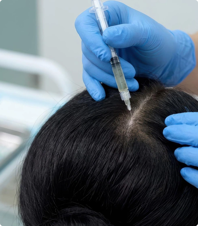 Close-up of GFC Plus treatment injection for hair restoration.