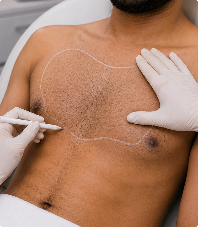Body hair transplant before and after results showing hair growth on the chest.
